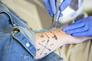 detatouage, tatouage, laser