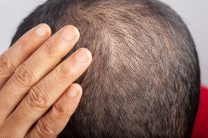 Méthode FUE et Rigenera