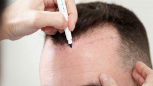 greffe de cheveux par technique FUE à paris